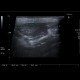 Lipoma of parotid gland: US - Ultrasound